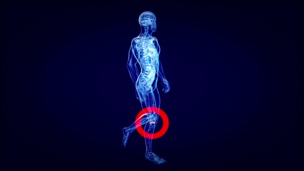 Abstract Animation Ostheoarthritis Knee Pathologies — Stock Video