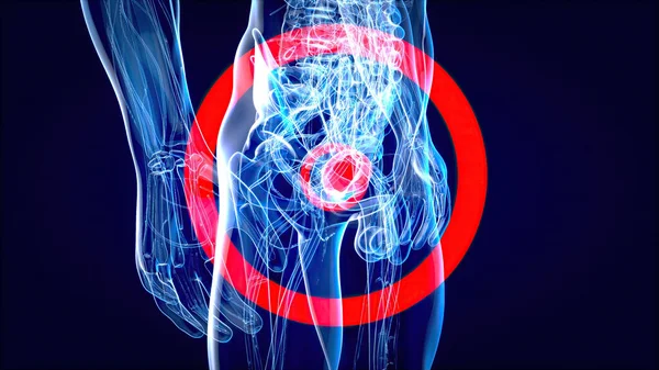 膀胱癌的三维抽象图例 图库图片