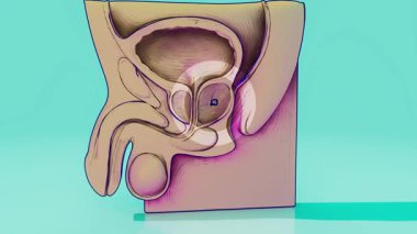 Prostat kanseri ve tıbbın kavramsal animasyonu