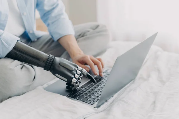 Bionic prosthesis and healthy arm. Hands of disabled girl are typing on keyboard of laptop. Handicapped european woman with artificial limb working on pc at home. Bionic fingers on buttons.
