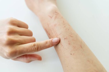 Doktor eli muayene ediyor, her tarafı çizilmiş, ellerinde kuru deri, ellerinde yaralar, sedef, vulgaris, egzama ya da diğer deri hastalıkları var. Çeşitli otoimmün genetik hastalıklar