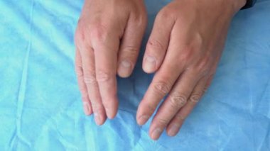 Etkilenmiş elleri gösteren bir adam var. Çevredeki maddelerle temas sonucu oluşan el kızarıklığı ya da temas dermatiti, endüstriyel kimyasallar, asitler, temizlik sıvıları gibi güçlü tahriş edici maddeler,