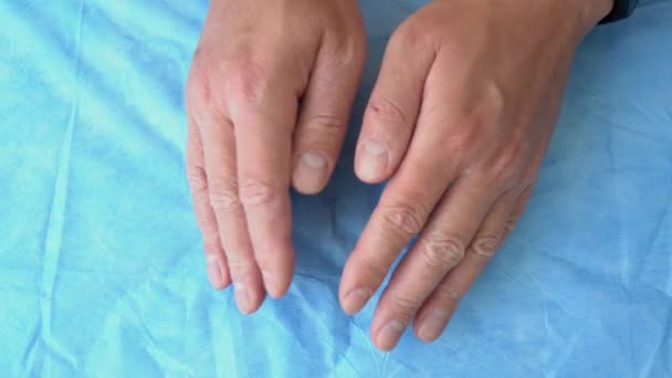 Человек Показывающий Пораженные Руки Закрывается Сыпь Руках Экзема Контактный Дерматит — стоковое видео