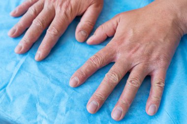 Bir adamın ellerinde sedef hastalığı. Mavi arka planda kurumuş erkek eli. Doktora git, egzama ve sedef tedavisi