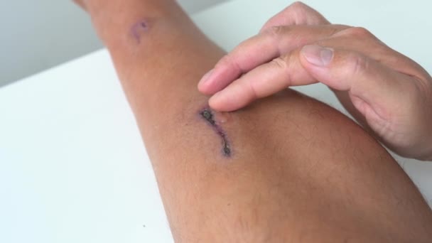 男子腿的特写 跌落后伤痕累累 男性手用药膏涂在新的伤疤上 用愈合胶治疗伤情部位 田径运动员训练意外 4K视频 — 图库视频影像