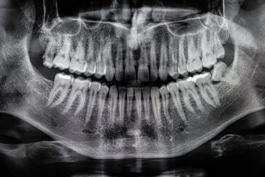Ortomografi, OPG X-ray DR dijital yirmilik dişler. panoramik film x ışını dişleri