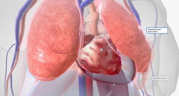 Congestive Heart Failure Signs and Symptoms 3D rendering