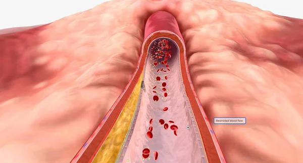 Cardiovascular disease is commonly caused by atherosclerosis and restricted blood flow through an artery.Insertion site in femoral vein 3D rendering