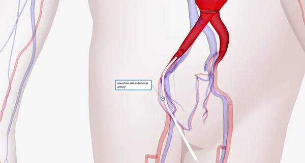 First a catheter, a thin tube, is inserted into a large vessel of the leg.3D rendering