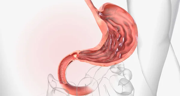 Peptic ulcers, gastric ulcers in the stomach and duodenal ulcers in the duodenum, the first part of the small intestine.3D rendering