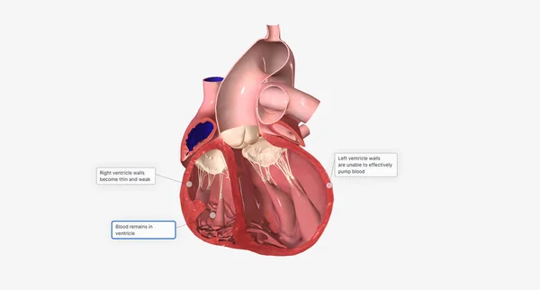 Right-sided heart failure is commonly caused by left-sided heart failure.3D rendering