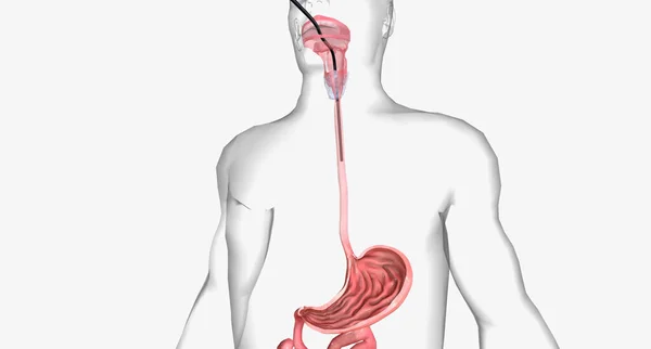An upper endoscopy or EGD is an invasive procedure used to look inside the upper digestive tract.3D rendering