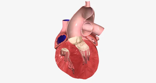 Congestive Heart Failure Right-Sided Diastolic 3D rendering