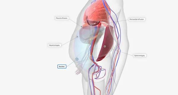 Congestive Heart Failure Signs and Symptoms 3D rendering