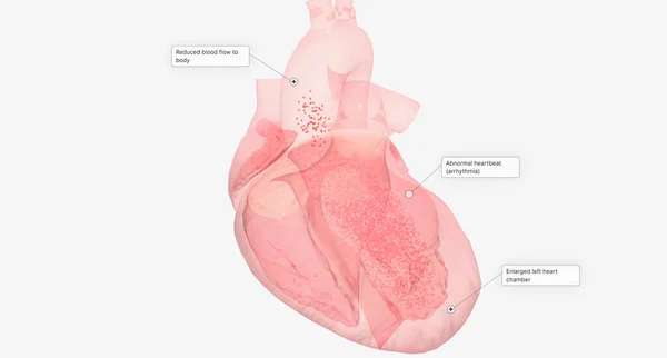 Heart with Congestive Heart Failure 3D rendering