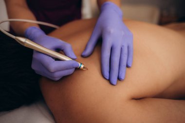 Bir güzellik uzmanı bir adamın sırtındaki papillomları temizler.