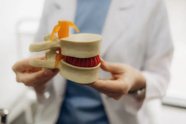 Stock image Doctor neurologist holds a mock spine with intervertebral hernia. Spine disease concept and sequestered or median hernia, isolate, spinal segment, osteochondrosis