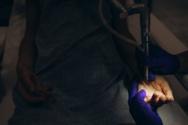 Doktor ve hemşire estetik tıp kliniğinde dermatolojik ameliyatın kaldırılması sırasında...