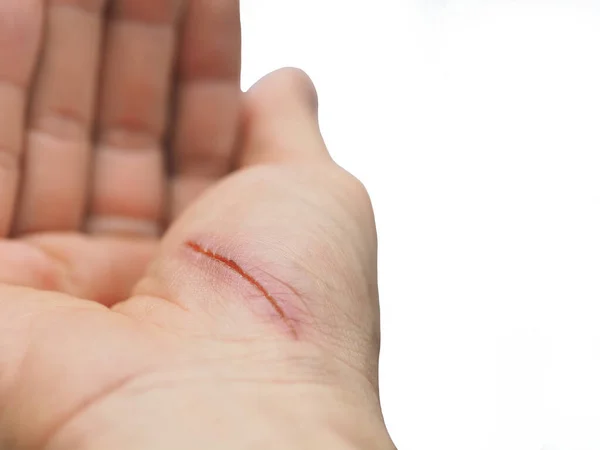 Τραυματισμένη Παλάμη Στο Δεξί Χέρι Λευκό Φόντο Χώρο Αντιγραφής — Φωτογραφία Αρχείου