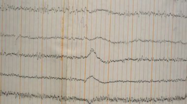 Eski bir kağıttaki depremin sismograf kaydı. Beynin elektriksel aktivitesindeki hastaların EEG 'si