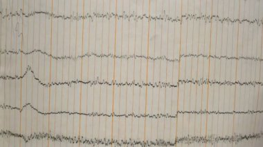 Eski bir kağıttaki depremin sismograf kaydı. Beynin elektriksel aktivitesindeki hastaların EEG 'si