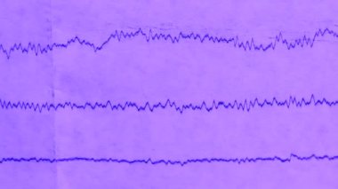 Eski kağıt üzerinde bir depremin sismografı, hastaların EEG 'si beynin elektriksel aktivitesindeki sorunlar.