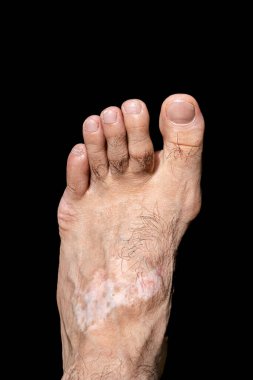 Kapalı alanda melanin kaybına neden olan deri hastalığı olan adam bacağı. Siyah tişörtlü ayak modeli vitiligo bozukluğundan muzdarip..