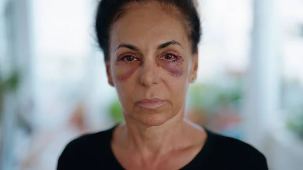 中年惊慌失措的女人在家中遭受家庭暴力 眼睛受了伤 — 图库照片