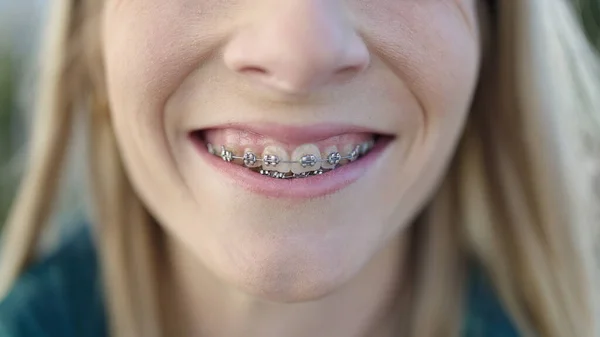 Young Blonde Woman Smiling Confident Showing Braces Street — Foto Stock