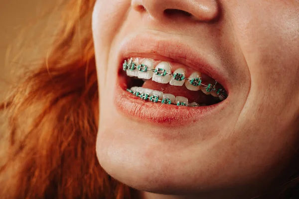 Menutup Gigi Dengan Kawat Gigi Pada Seorang Gadis Jahe — Stok Foto