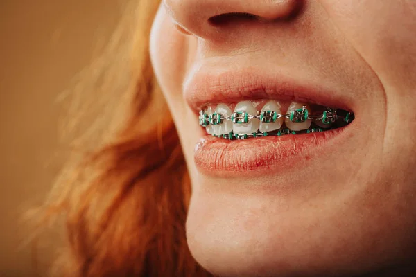 Nahaufnahme Eines Ingwermädchens Das Mit Ihren Zahnspangen Studio Lächelt — Stockfoto