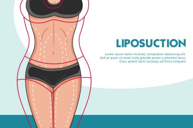 Liposuction prosedüründen önce ve sonra kadın vücudunun farklı olduğunu gösteren bir çizim. Kilo kaybı ve sağlık konsepti