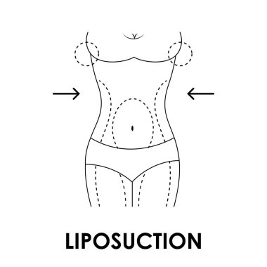 Liposuction prosedüründen önce ve sonra kadın vücudunun farklı olduğunu gösteren bir çizim. Kilo kaybı ve sağlık konsepti