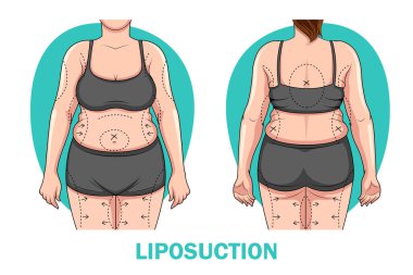 Liposuction prosedüründen önce ve sonra kadın vücudunun farklı olduğunu gösteren bir çizim. Kilo kaybı ve sağlık konsepti