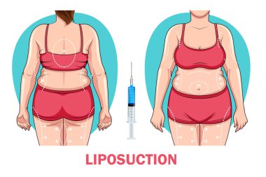 Liposuction prosedüründen önce ve sonra kadın vücudunun farklı olduğunu gösteren bir çizim. Kilo kaybı ve sağlık konsepti