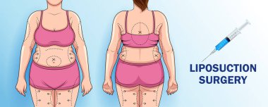 Liposuction prosedüründen önce ve sonra kadın vücudunun farklı olduğunu gösteren bir çizim. Kilo kaybı ve sağlık konsepti