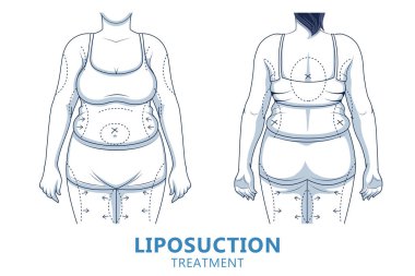 Liposuction prosedüründen önce ve sonra kadın vücudunun farklı olduğunu gösteren bir çizim. Kilo kaybı ve sağlık konsepti