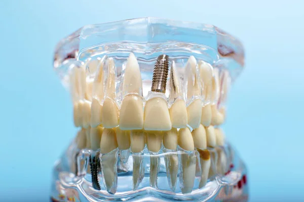 蓝色背景下的牙龈模型 牙科医生假牙 牙根特写 — 图库照片