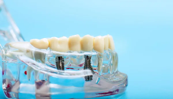 蓝色背景下的牙龈模型 牙科医生假牙 牙根特写 — 图库照片