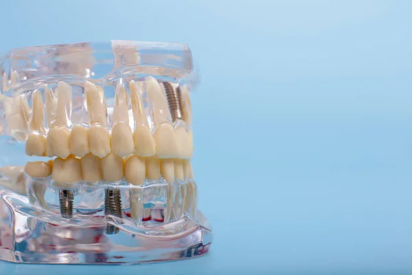 Model Szczęki Dentystycznej Niebieskim Tle Dentysta Protezy Zębów Dziąsła Korzenie — Zdjęcie stockowe
