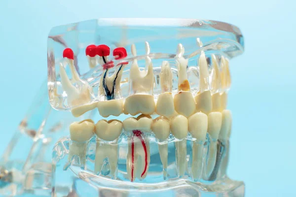 Porównaj Model Zęba Zęba Metalowym Drutem Dentystycznym — Zdjęcie stockowe