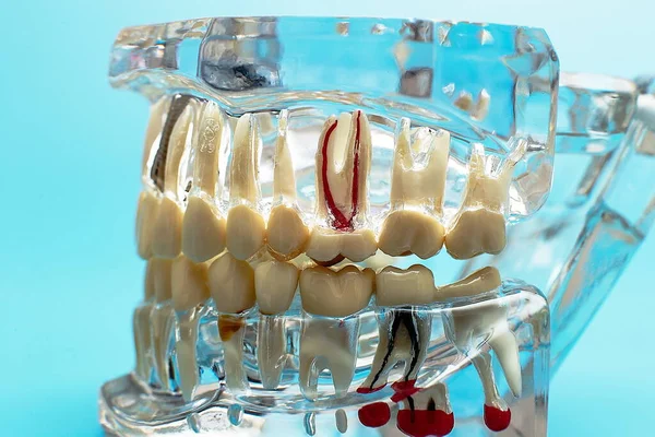 Narzędzie Dentystyczne Modelem Koncepcji Opieki Stomatologicznej — Zdjęcie stockowe