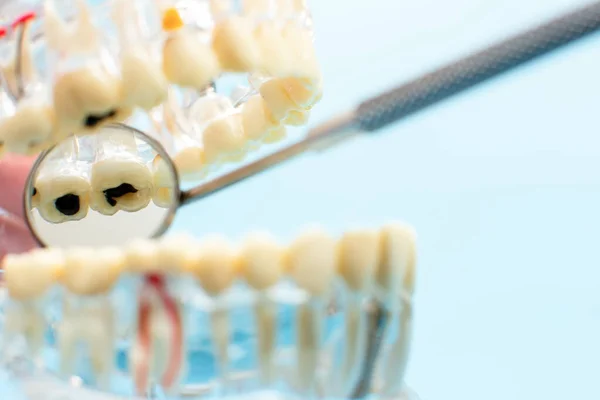 Compare Modelo Dente Modelo Dente Com Fio Metal Dental — Fotografia de Stock