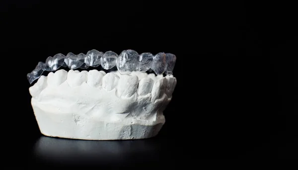 stock image Dental jaw model over black background.Transparent invisible dental aligners or braces aplicable for an orthodontic dental treatment