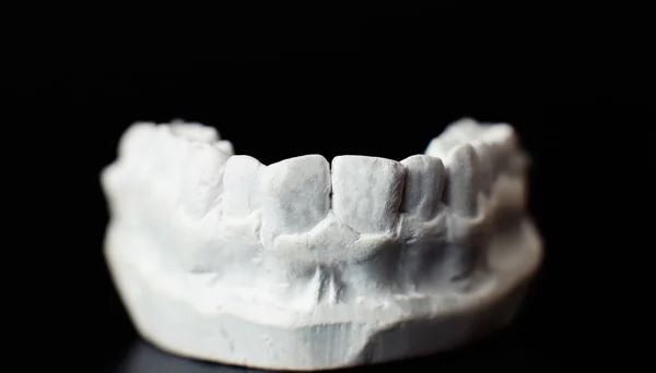 Tandkäken Modell Över Svart Bakgrund Tandläkare Tandproteser Tänder Tandkött Rötter — Stockfoto