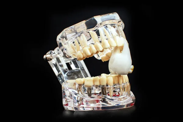 Modelo Mandíbula Dental Sobre Fondo Negro Alineadores Dentales Invisibles Transparentes —  Fotos de Stock