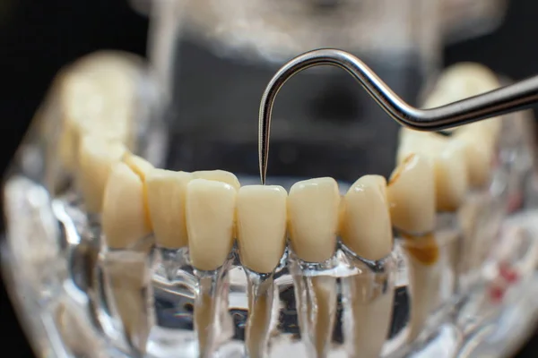 Modèle Mâchoire Dentaire Sur Fond Noir Aligneurs Appareils Dentaires Invisibles — Photo