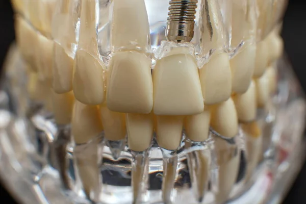 下颌骨模型覆盖黑色背景 可用于牙齿矫正治疗的透明隐形牙槽或牙托 — 图库照片