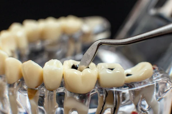 黒の背景に歯科顎モデル 歯科矯正治療に適用される透明目に見えない歯科用アライナーまたはブレース — ストック写真