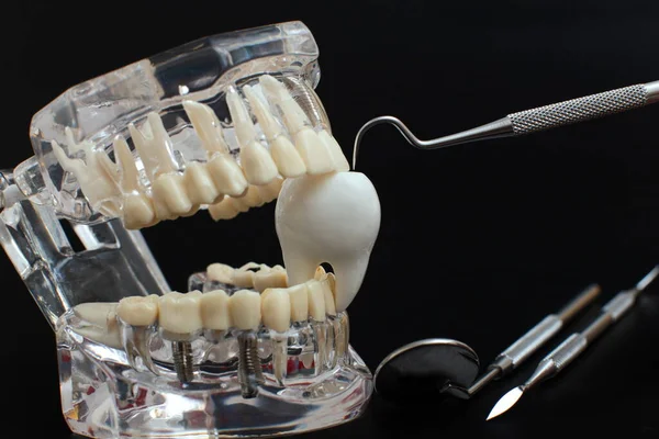 Model Szczęki Dentystycznej Czarnym Tle Przezroczyste Niewidoczne Złącza Dentystyczne Lub — Zdjęcie stockowe